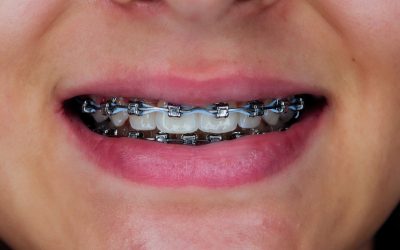 Taking Care of Your Teeth and Braces!