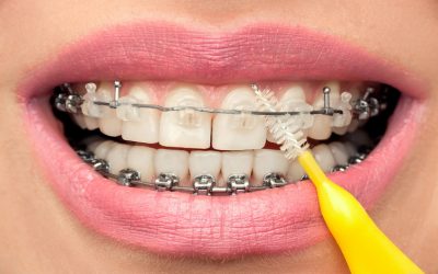 What is Expected from You during Orthodontic Treatment