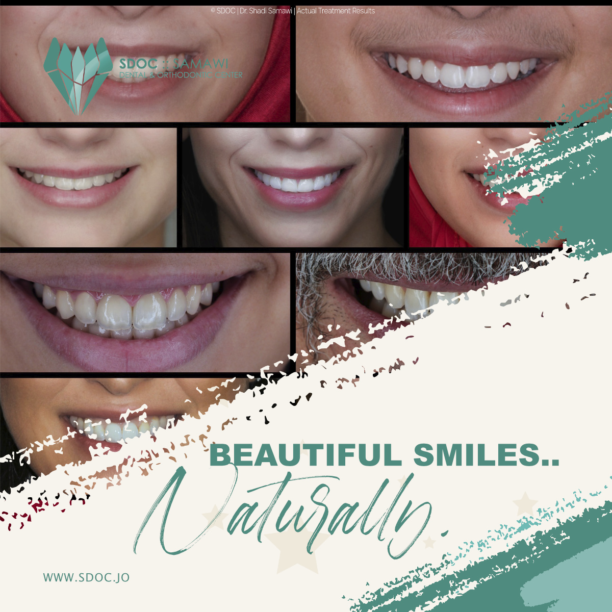 Transform Your Smile with Clear Aligners: A Modern Approach