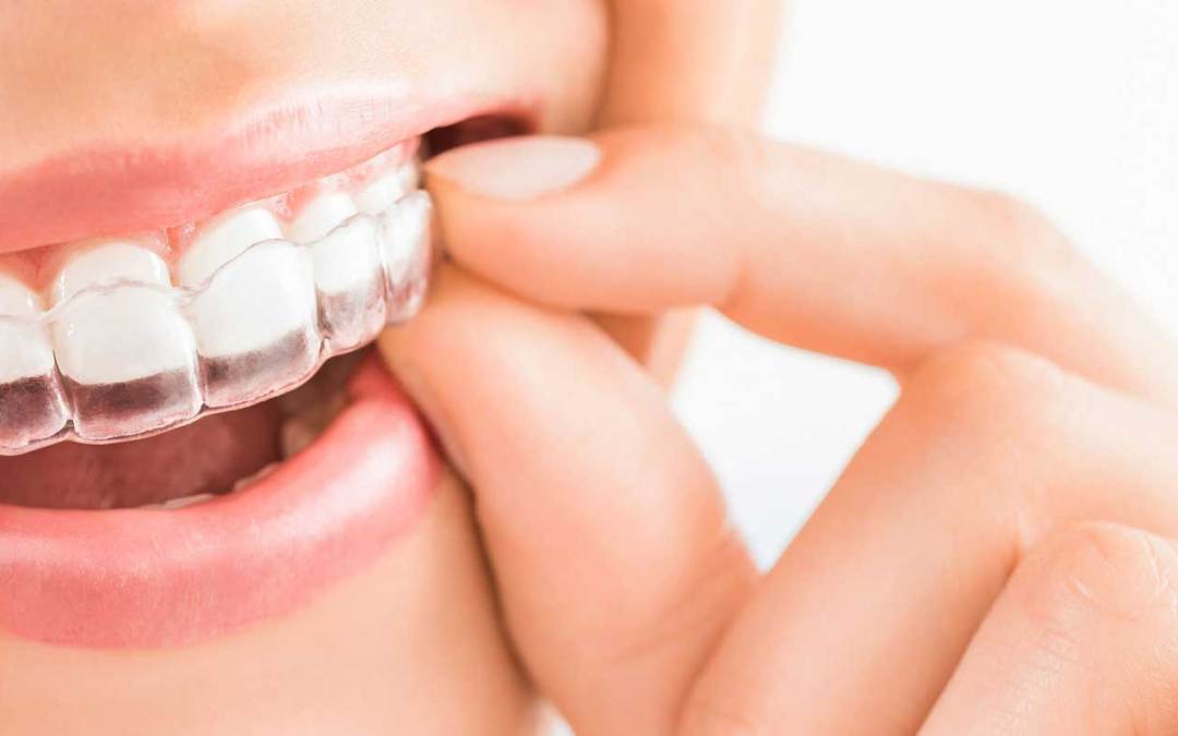 What You Need to Know About Clear Aligner Treatment
